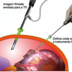 Videolaparoscopia (videocirurgia)